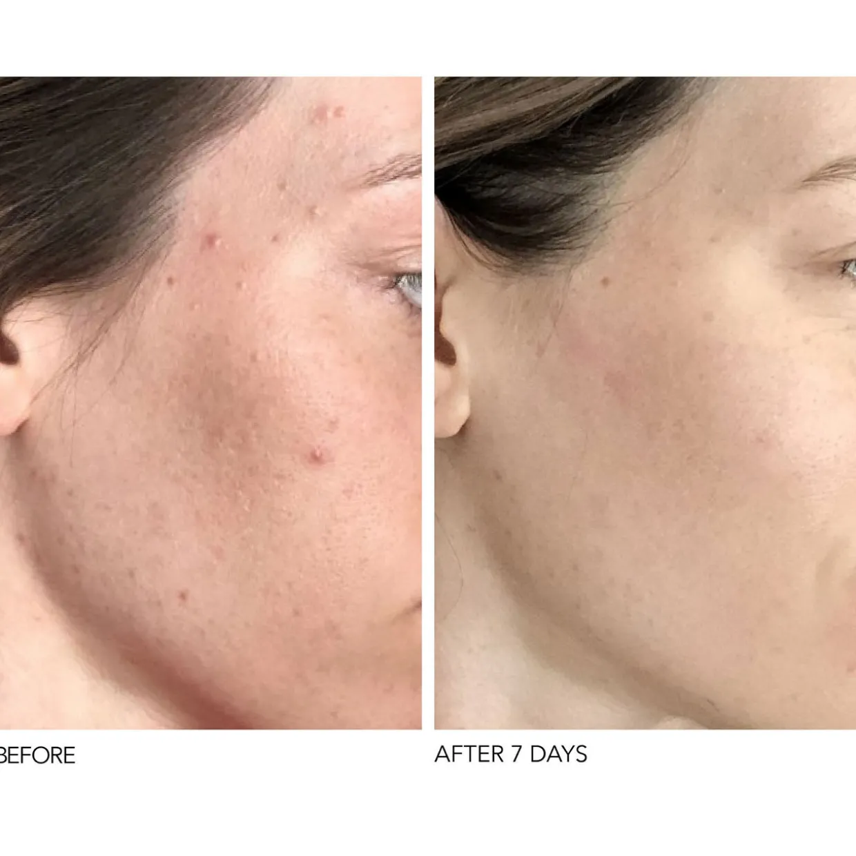 Alpha Beta® Universal Daily Peel 5 Pack